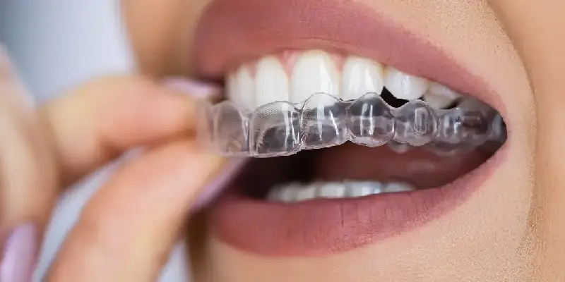 Clear Aligner 1