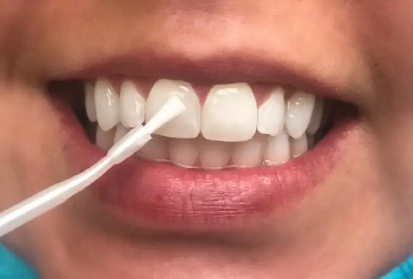 ICON Resin Infiltration Front