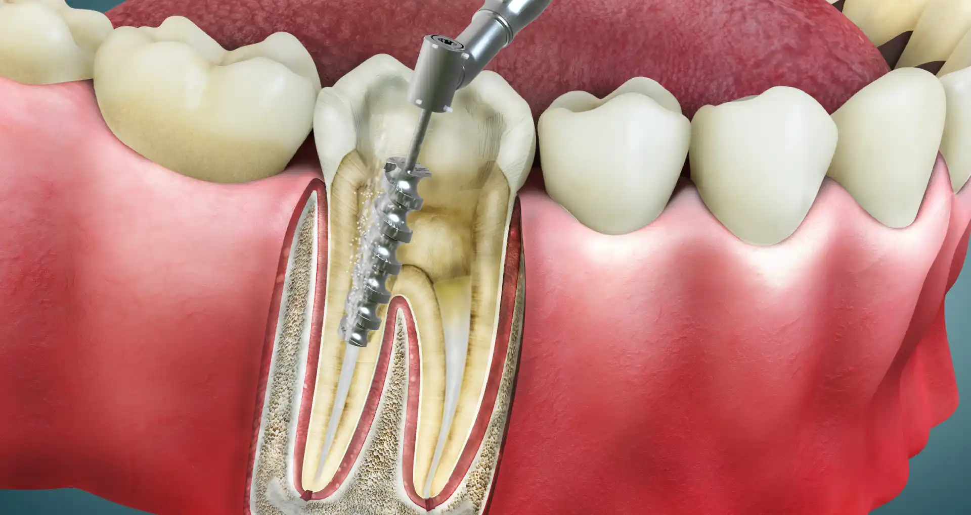 Root Canals