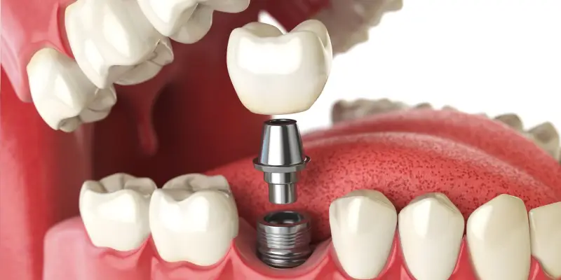 Surgical Guided Implants 2
