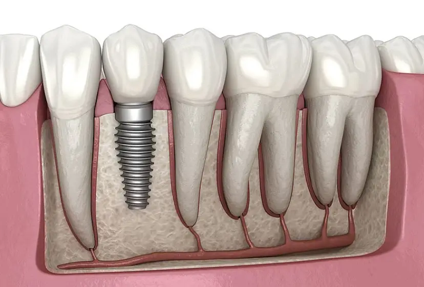 Surgical Guided mplants Front
