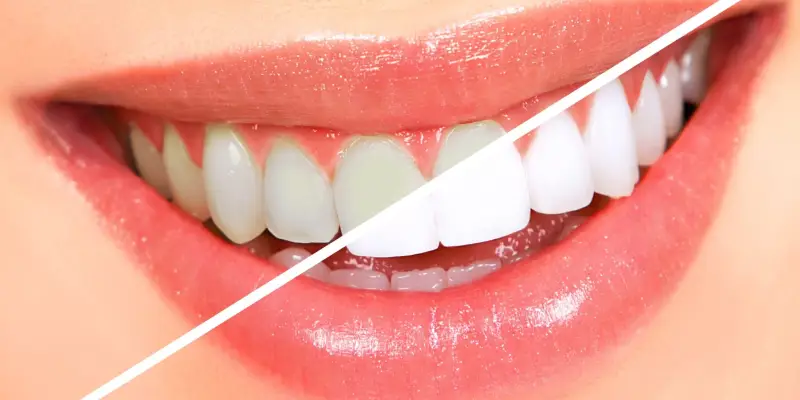 Teeth Whitening v1
