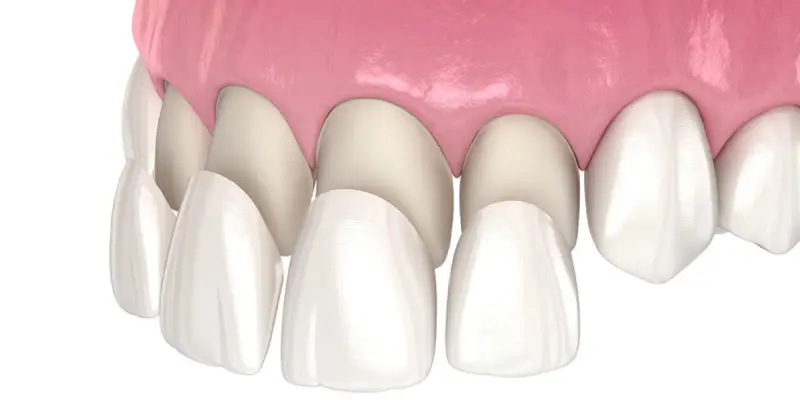 Veneer v1