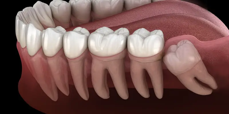 Wisdom Teeth Removal